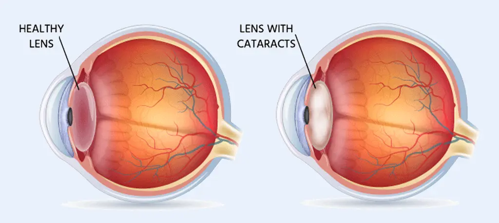 cataract surgeon in indore
